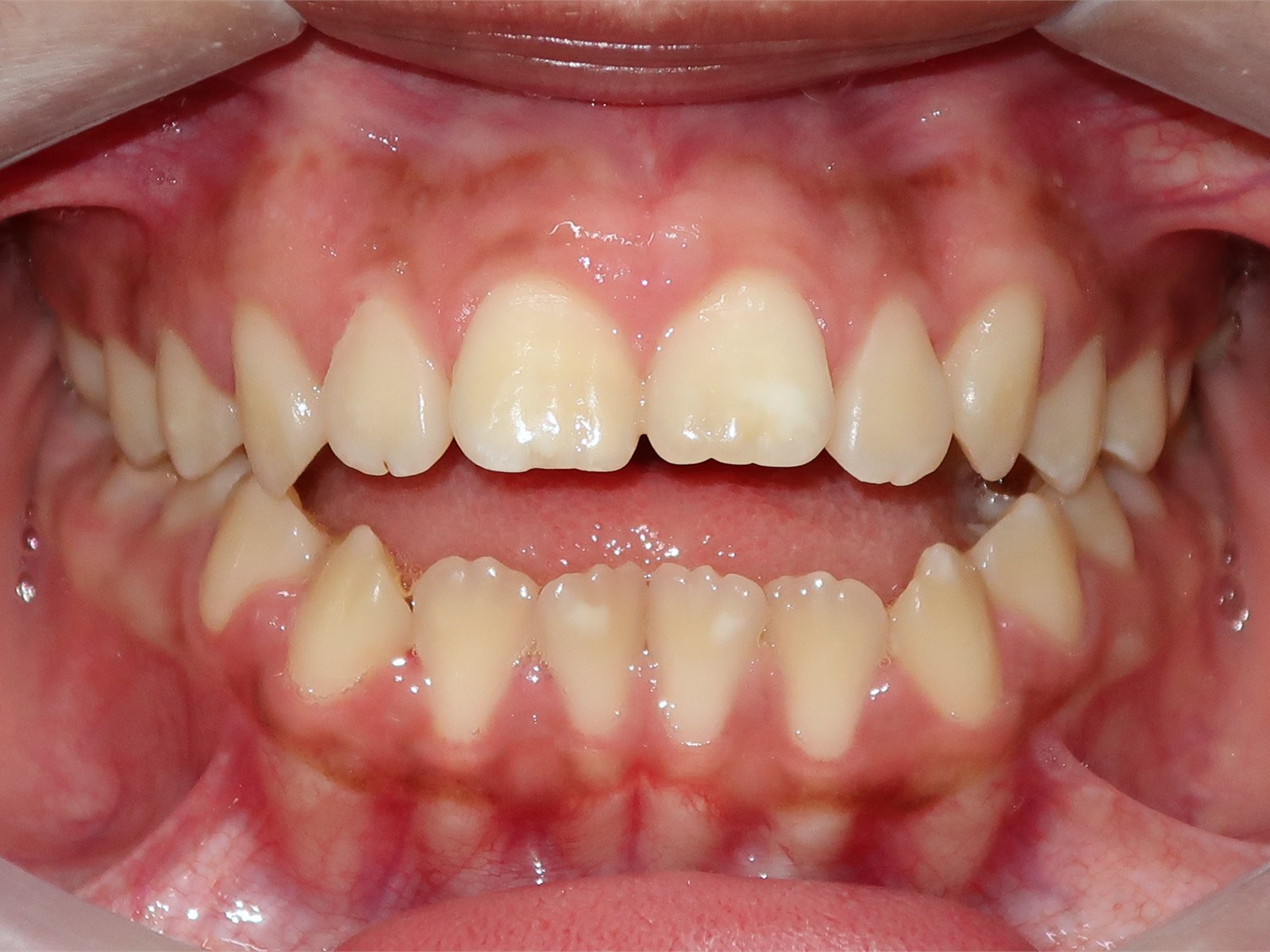 Registro intraoral de caso ortodôntico acompanhado pela Meta Odonto