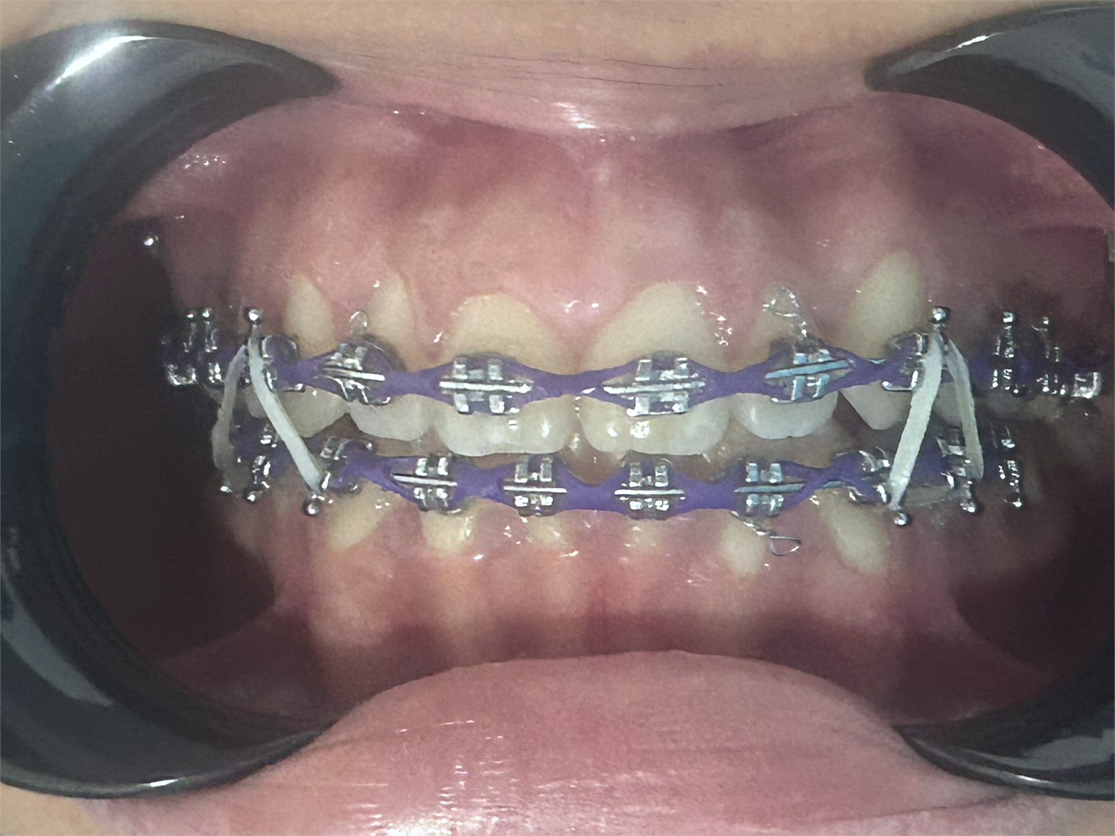 Etapa com aparelho em caso ortodôntico acompanhado pela Meta Odonto
