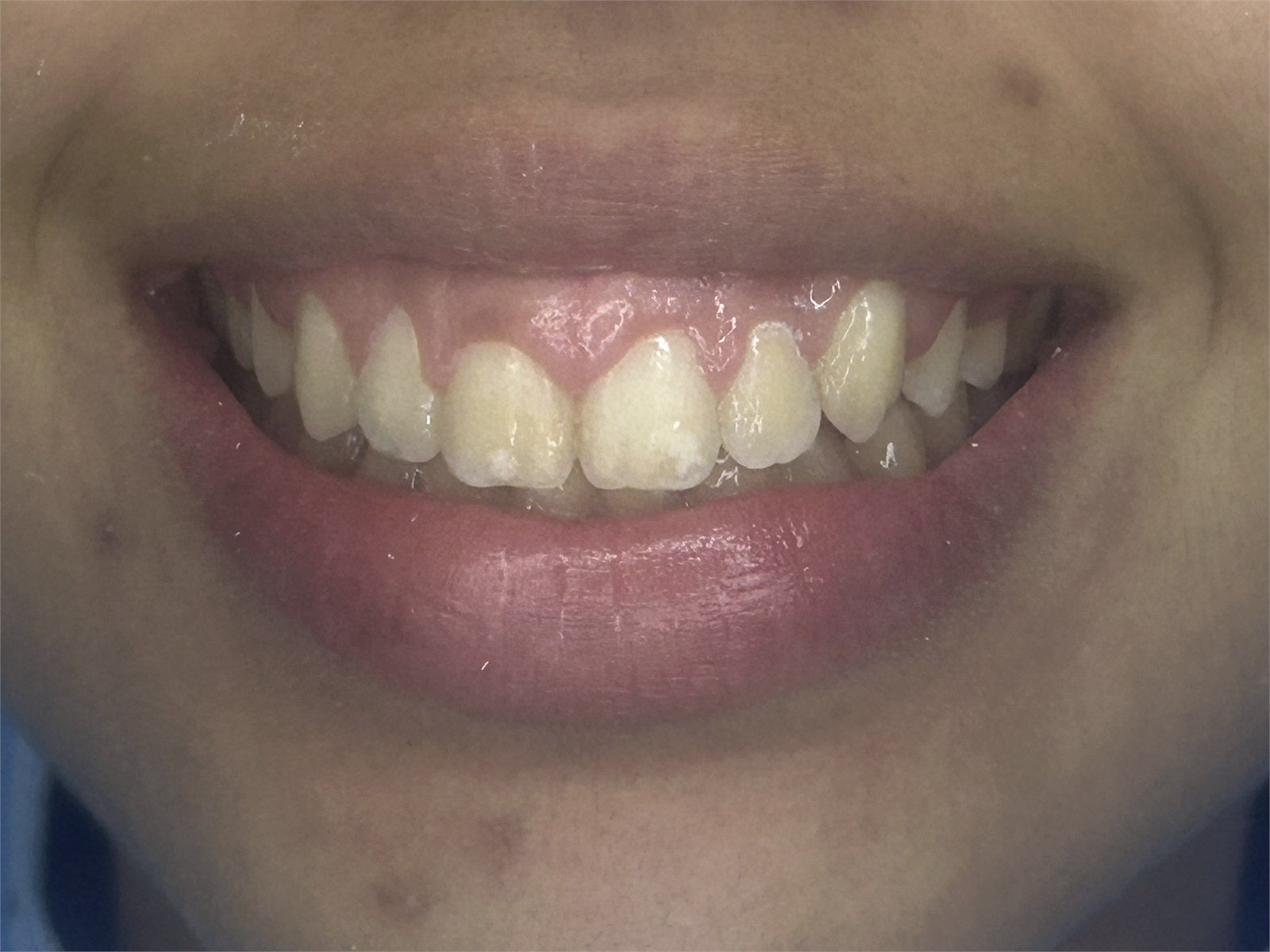Registro do sorriso em caso ortodôntico acompanhado pela Meta Odonto